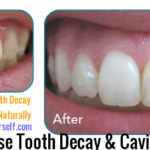 How to Remineralize Teeth, Reverse Tooth Decay Naturally