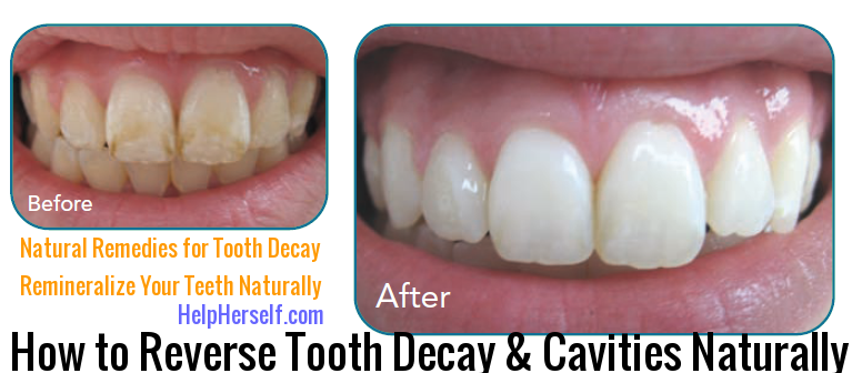 Reverse cavities and tooth decay naturally - remineralize teeth.