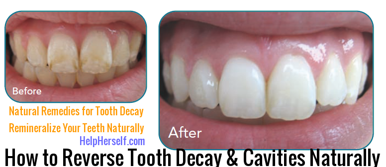 reversing tooth decay