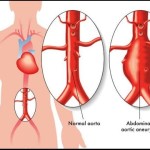 How to Prevent a Deadly Ruptured Aorta