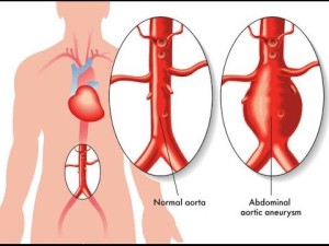 How to prevent ruprured aorta.