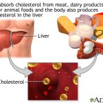 Atherosclerosis (Hardening of the Arteries): Natural Treatment and Prevention